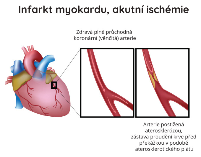 Infarkt myokardu - akutní ischémie