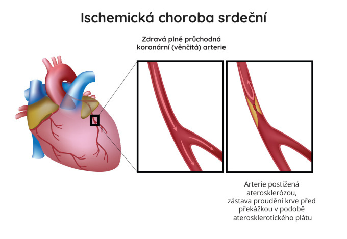 Ischemická choroba srdeční