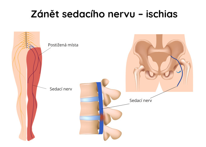Zánět sedacího nervu - ischias