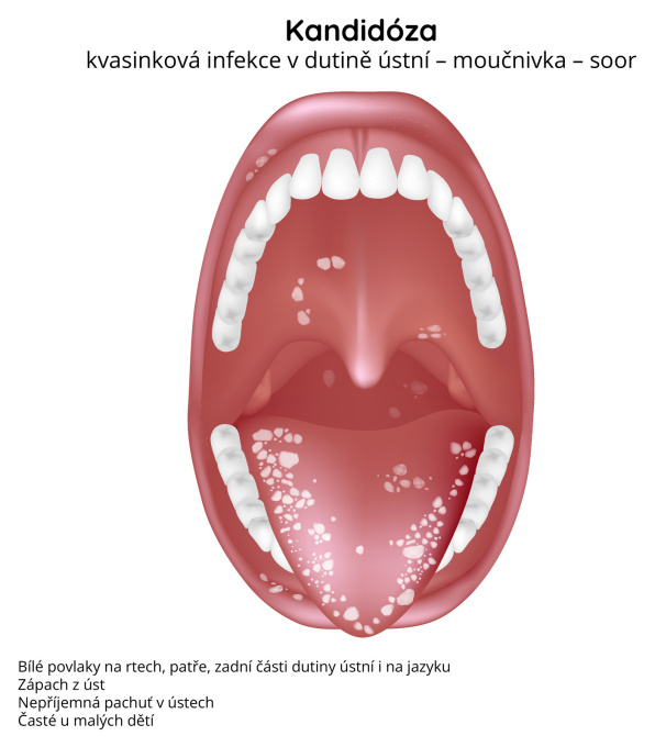 Kandidóza (kvasinková infekce v dutině ústní)