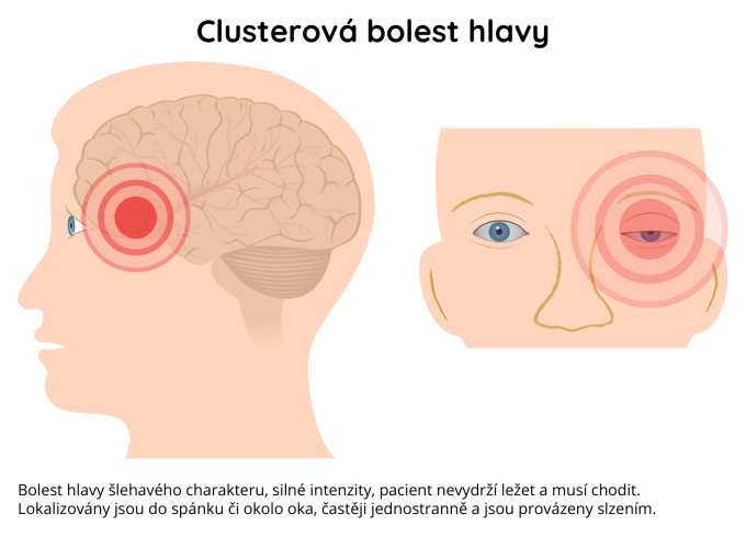 Clusterová bolest hlavy 