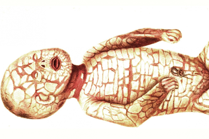 Harlequin Ichthyosis