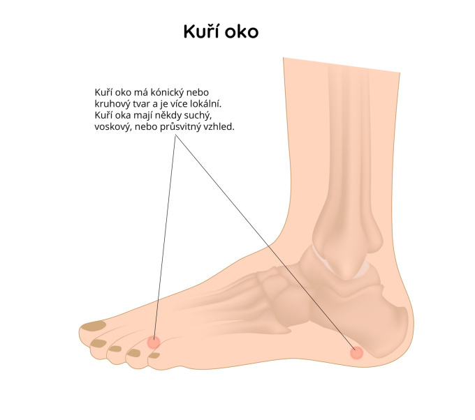 Kuří oko, clavus