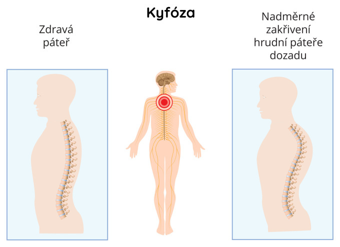 Kulatá záda - Kyfóza