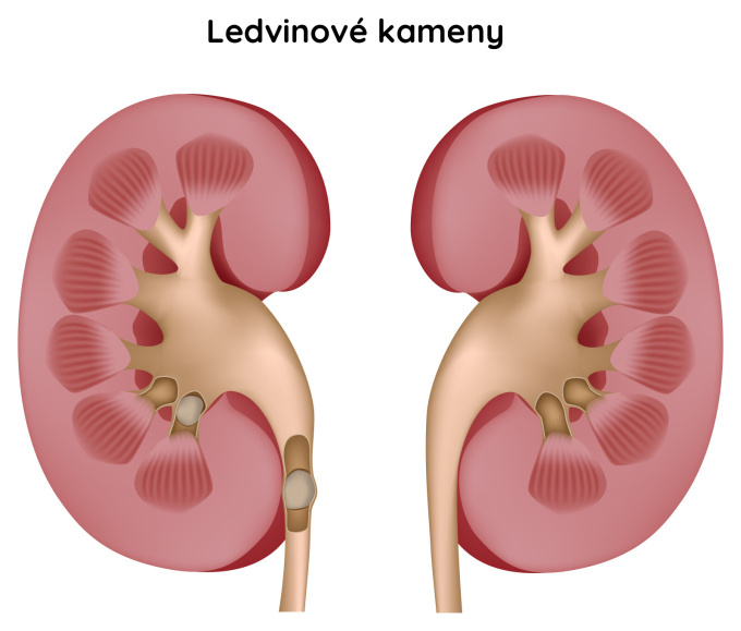Ledvinové kameny (lithiáza)