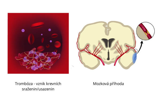 Trombóza příznakem Leidenská mutace
