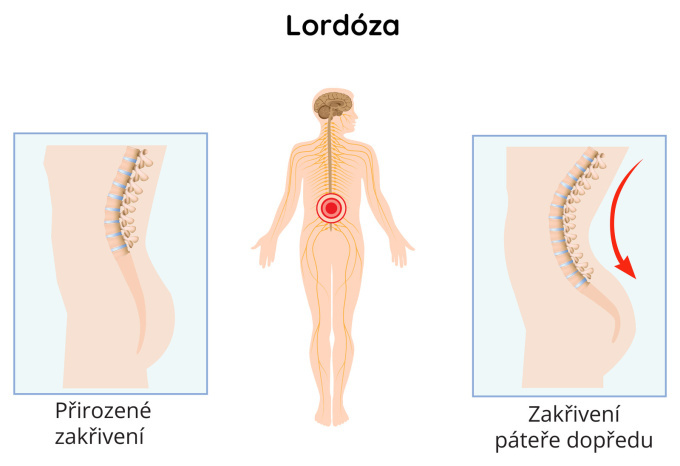 Lordóza páteře