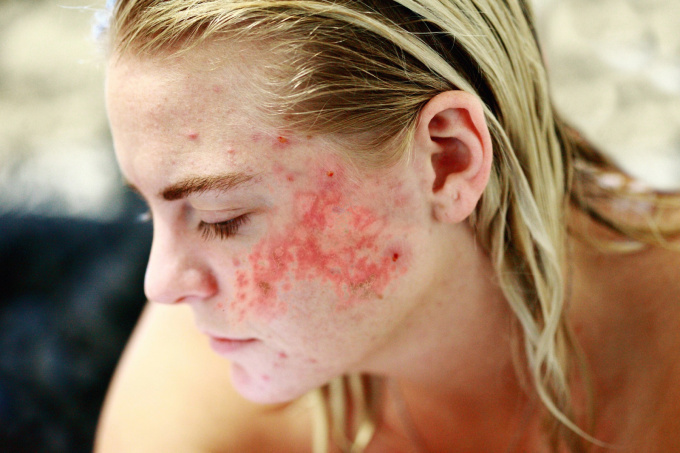 Lupus erythematodes