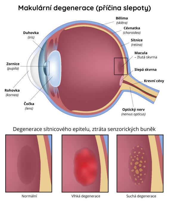 Makulární degenerace - příčina-slepoty