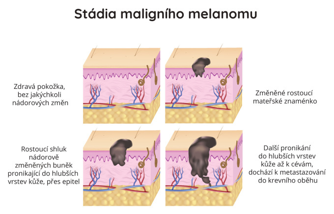 Stádia maligního melanomu