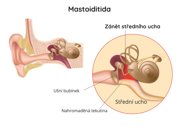 Zánět středního ucha