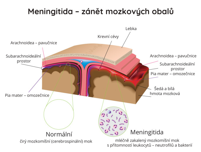 Meningitida - zánět mozkových blan