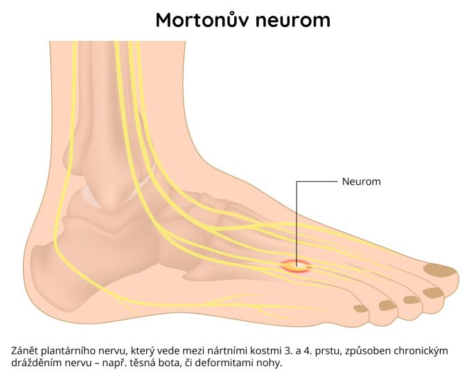 Mortonův neurom