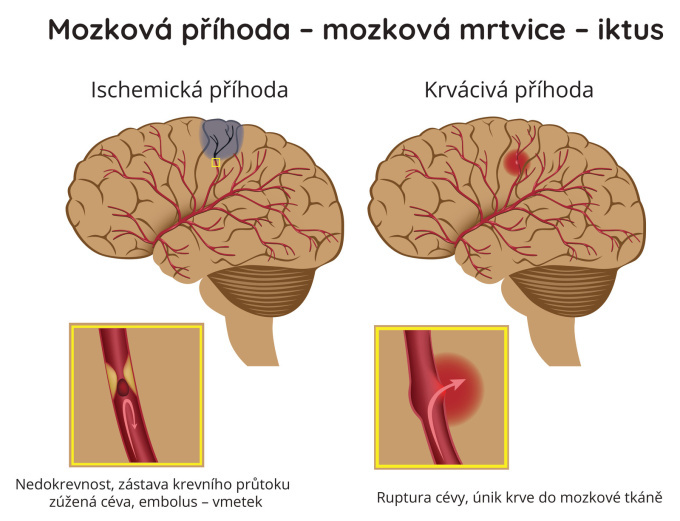 Mozková mrtvice - ischemická a krvácivá příhoda
