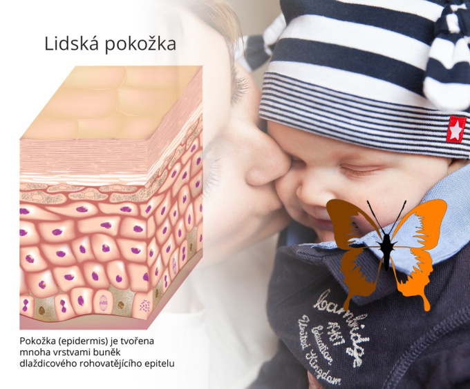 Nemoc motýlích křídel