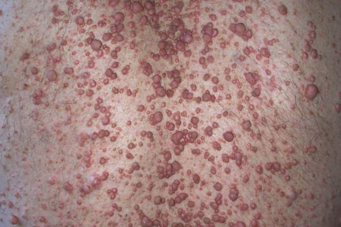 Neurofibromatóza