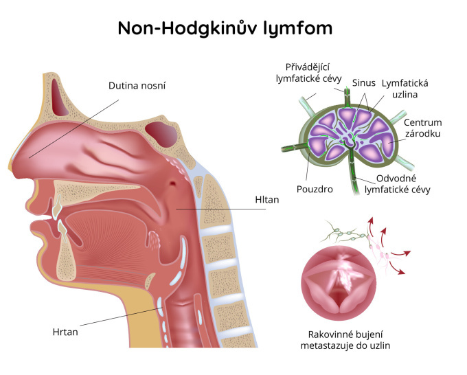Non-Hodkinův lymfom, NHL