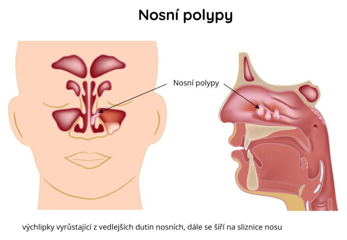 Nosní polypy