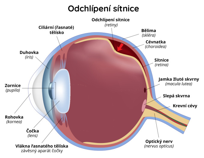Odchlípení sítnice (retiny)