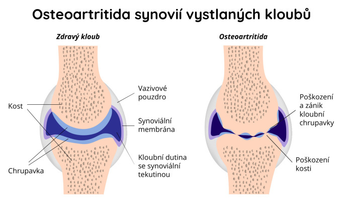 Osteoartritida synovií vystlaných kloubů