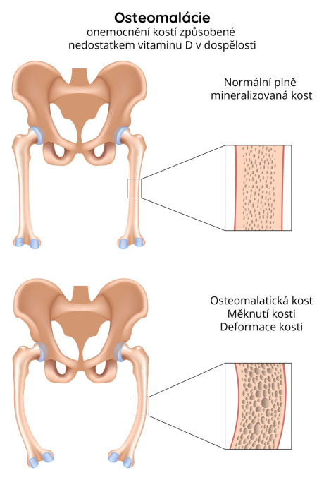 Osteomalácie