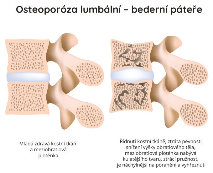 Osteoporoza lumbální - bederní páteře