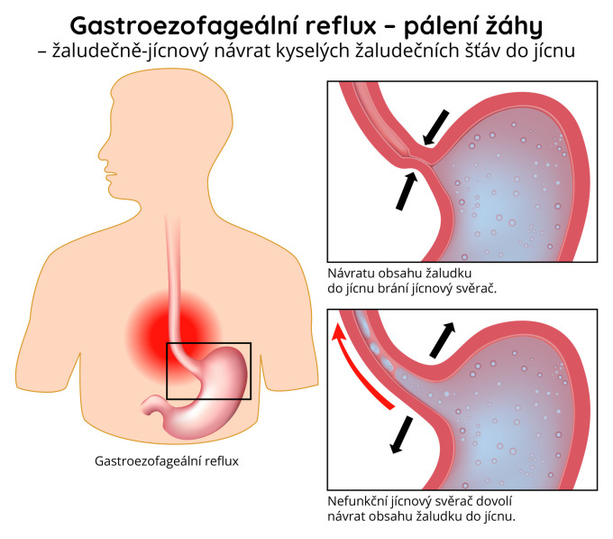 Gastroezofageální reflux - pálení žáhy