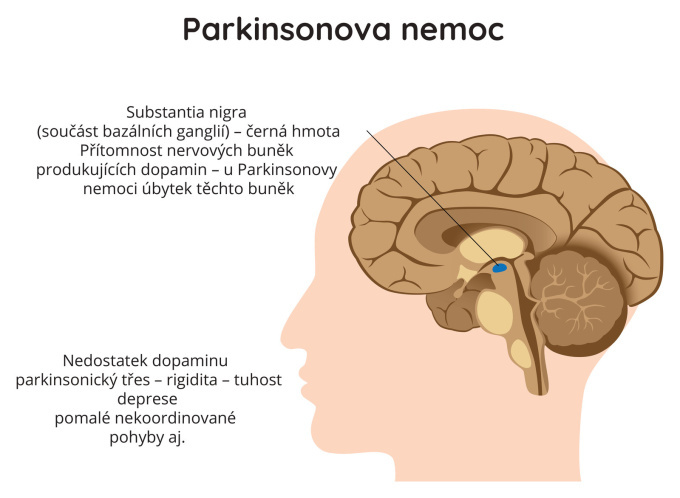 Parkinsonova nemoc - Substania nigra