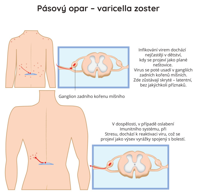 Pásový opar - varicella zoster