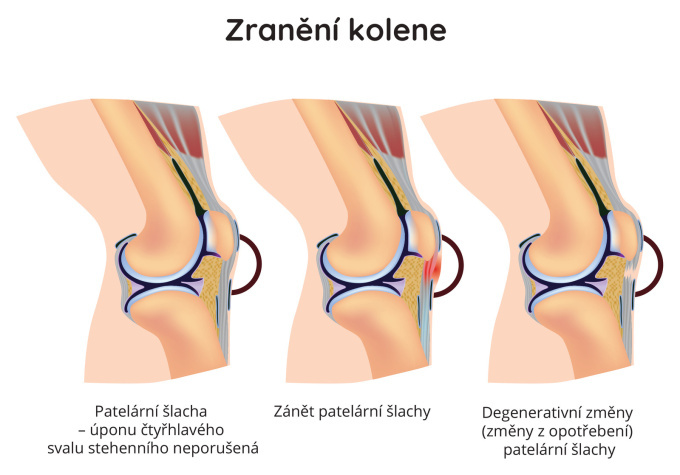 Zranění kolene
