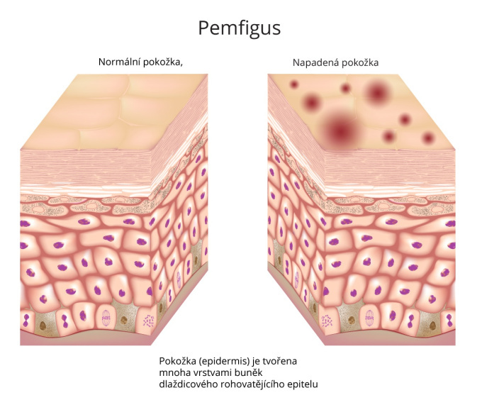 pemfigus.jpg