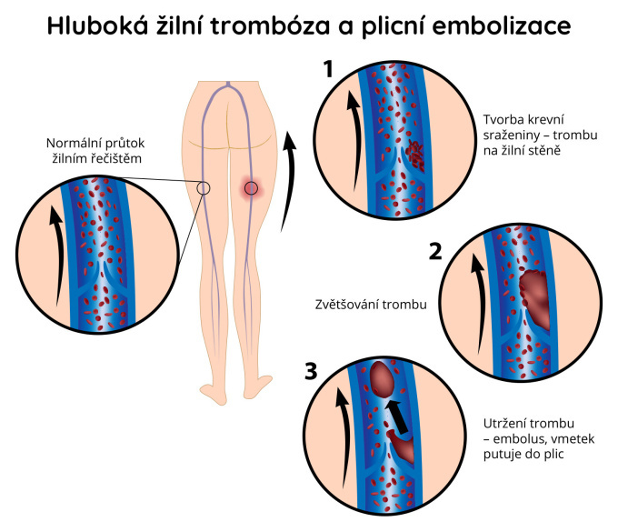 Hluboká žilní trombóz a plicní embolizace