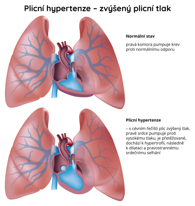 Plicní hypertenze - zvýšený plicní tlak
