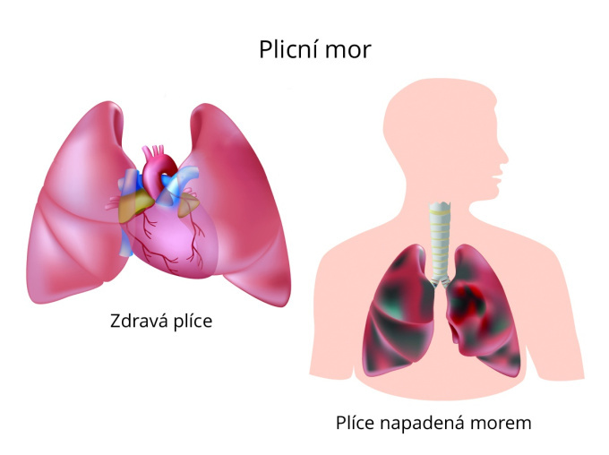Plicní mor
