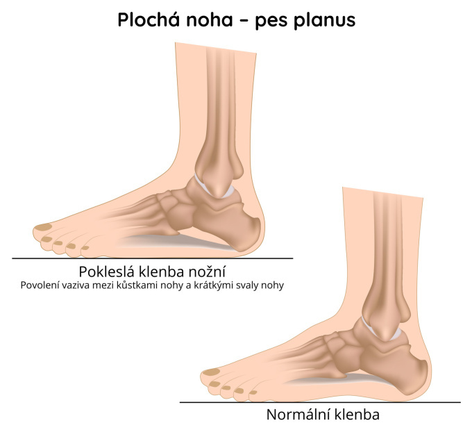 Plochá noha (pes planus)
