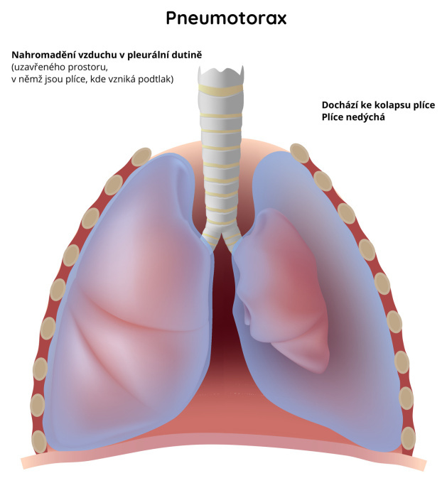 Pneumotorax (nahromadění vzduchu v pleurální dutině)