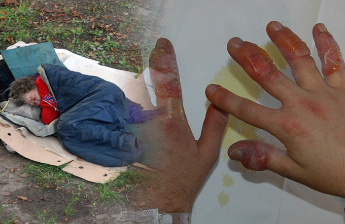 příznaky podchlazení, hypotermie