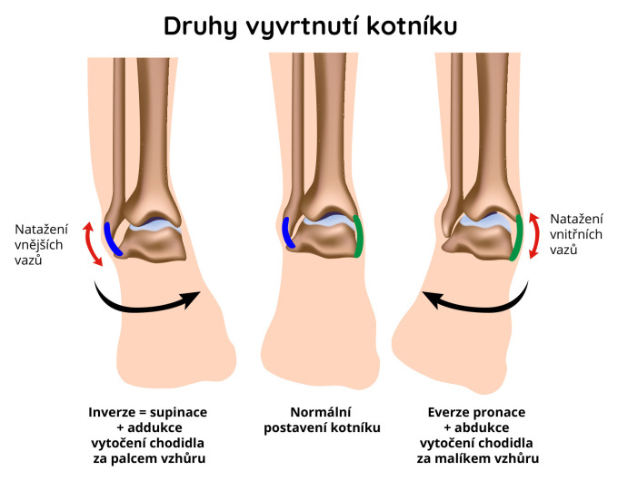 Druhy vyvrtnutí kotníku