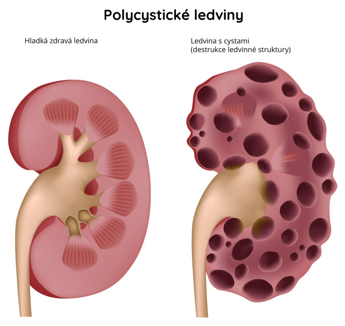 Polycystické ledviny