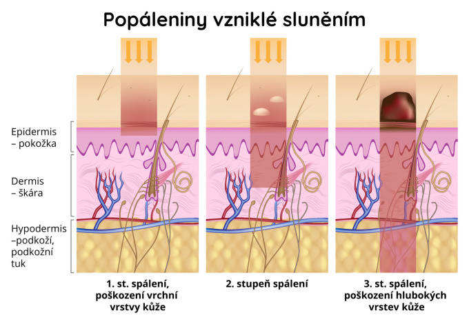 Popáleniny vzniklé sluněním 