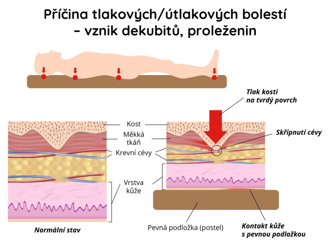 Příčina tlakových bolestí, vznik dekubitů (proleženin)