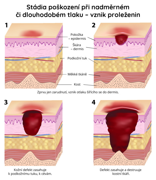Stádia poškození při nadměrném či dlouhodobém tlaku (vznik proleženin)