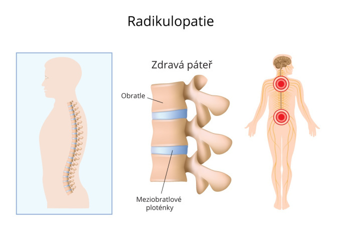 Radikulopatie