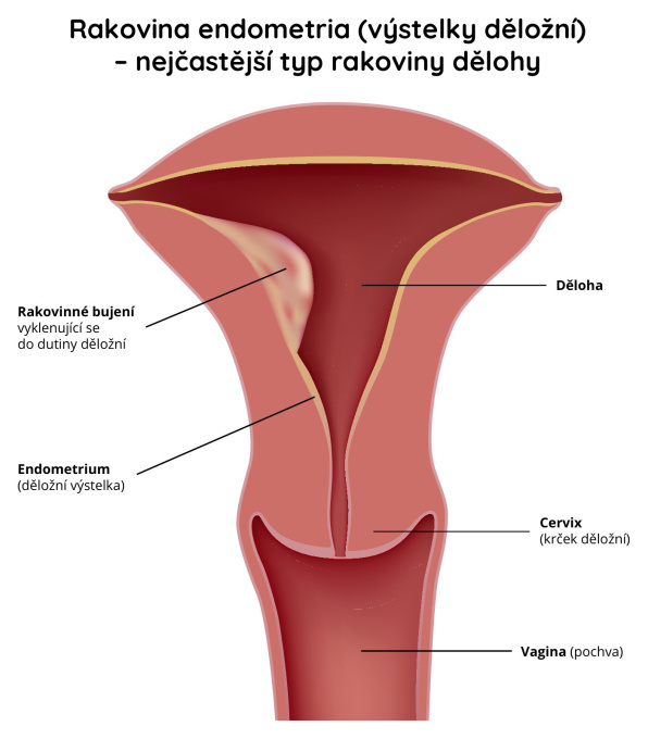 Rakovina endometria (výstelky děložní) - nejčastější typ rakoviny dělohy