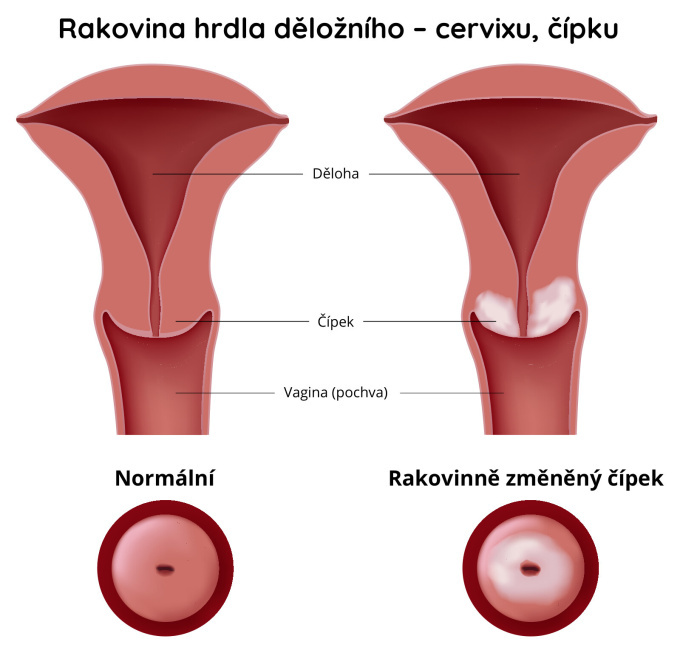 Rakovina hrdla děložního čípku