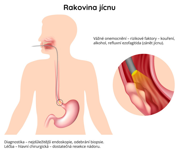 Rakovina jícnu