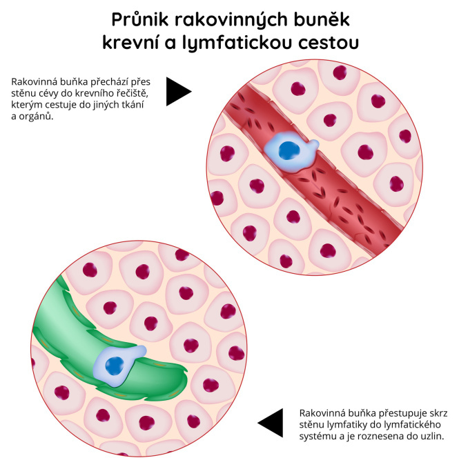 Průnik rakovinných buněk krevní a lymfytickou cestou