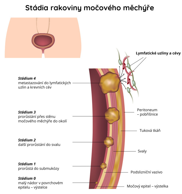 Stádia rakoviny močového měchýře