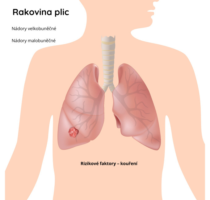 Rakovina plic