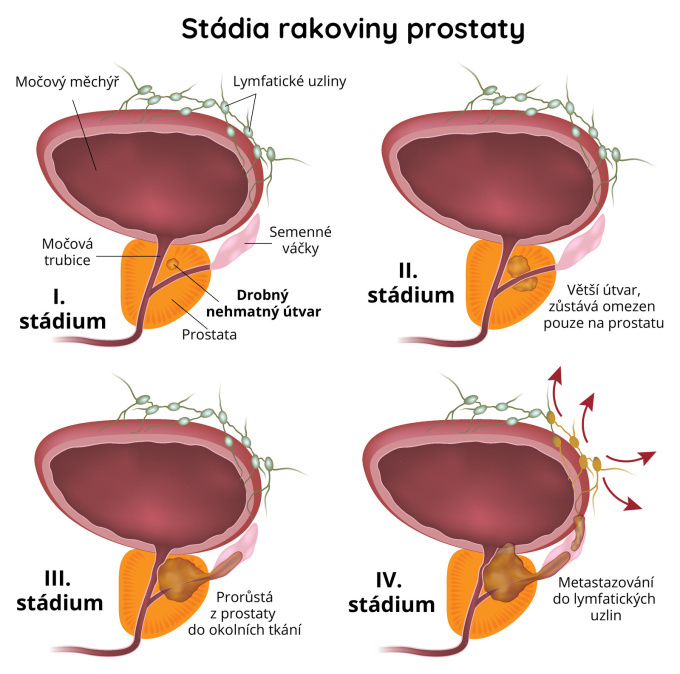 Stádia rakoviny prostaty